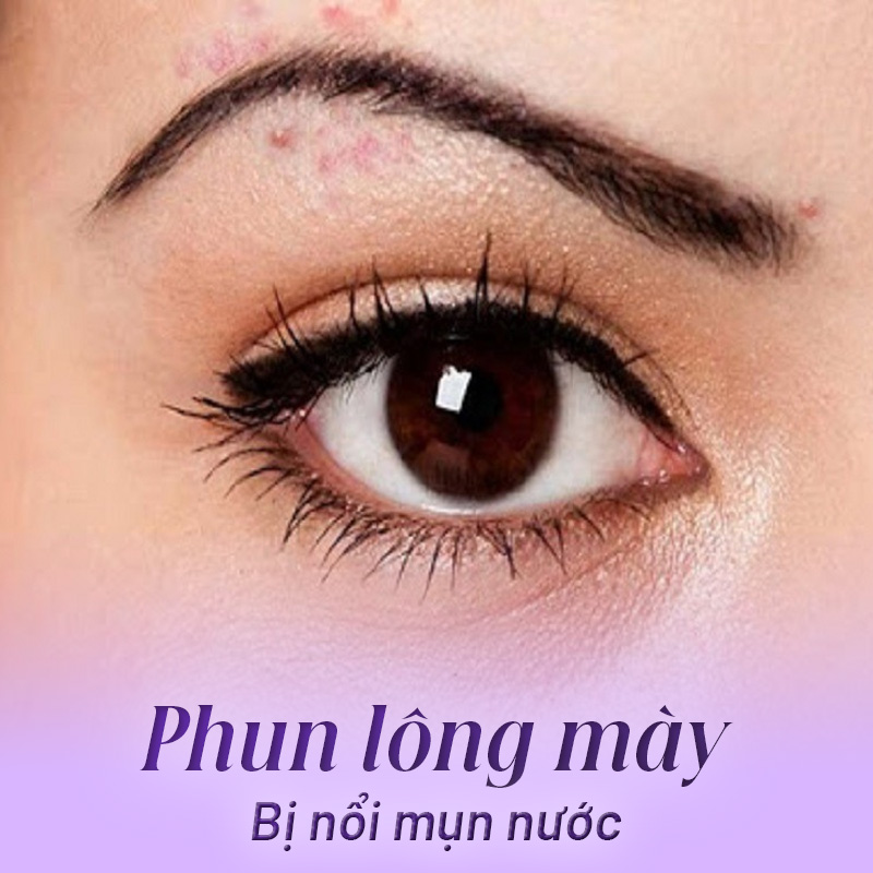 phun lông mày bị nổi mụn nước có sao không