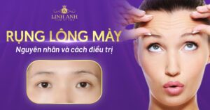 rụng lông mày