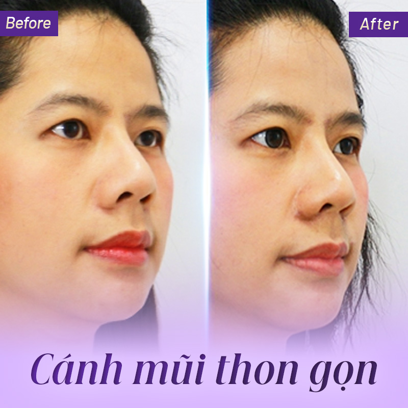 thẩm mỹ cuộn cánh mũi