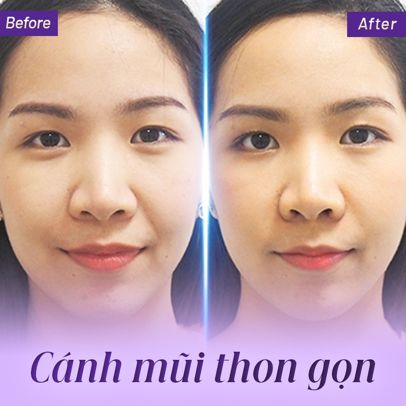 thu gọn cánh mũi