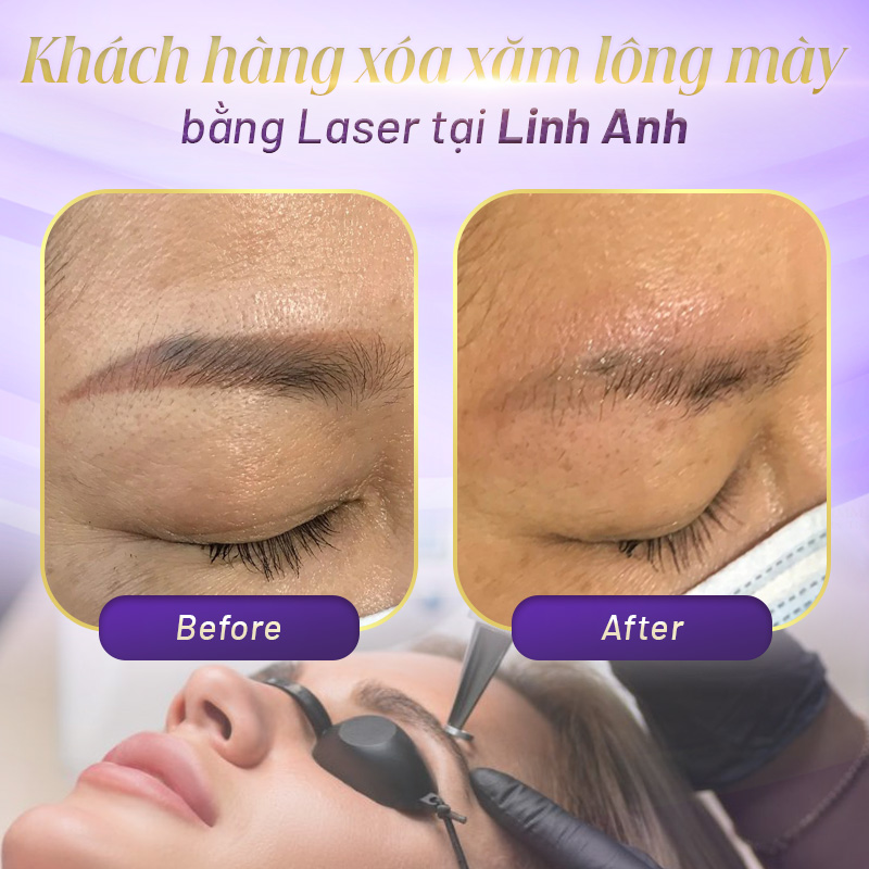 xóa laser lông mày chăm sóc ra sao