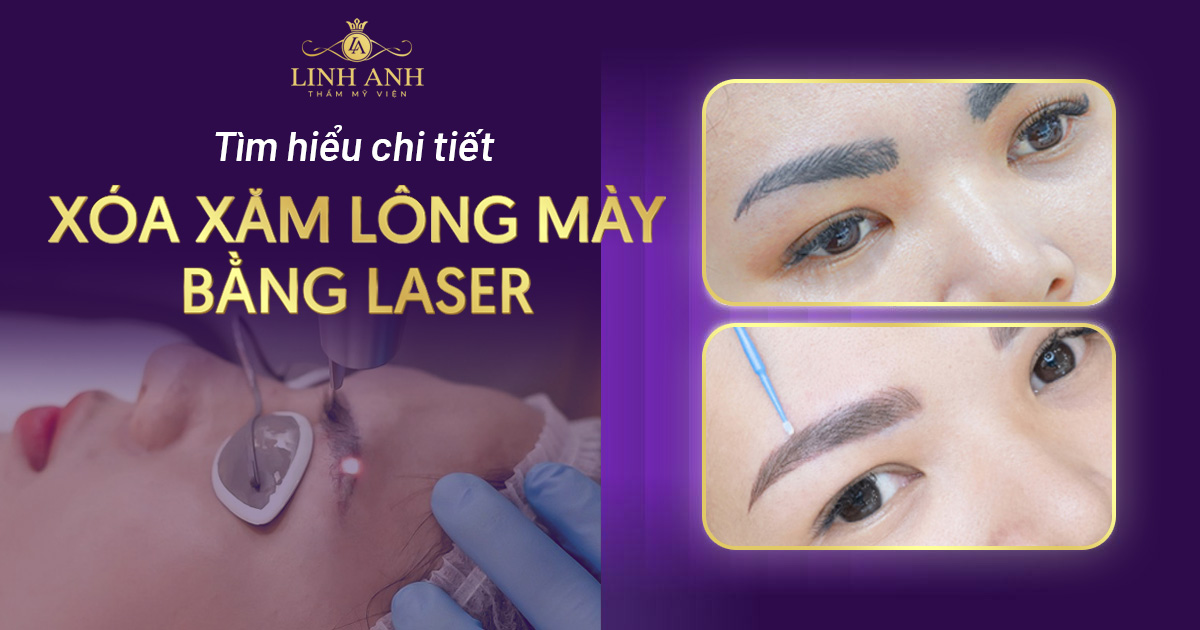 Xóa xăm lông mày bằng laser có hết không? Có để lại sẹo không?