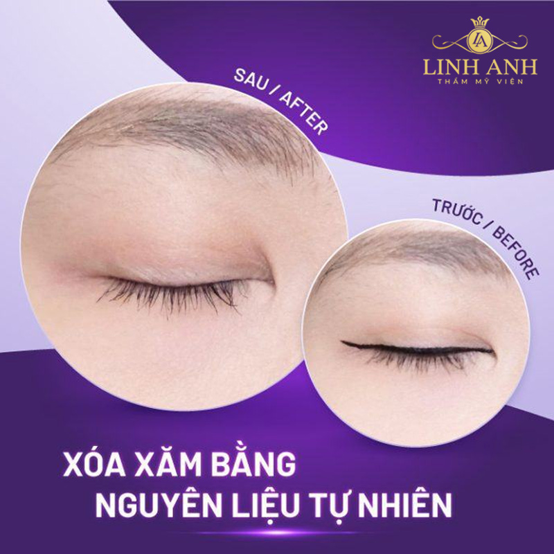 cách xóa xăm mí mắt