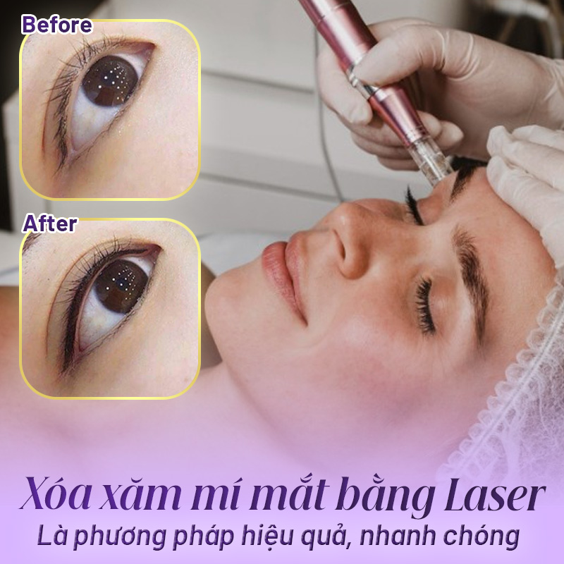 Xóa phun xăm mí mắt