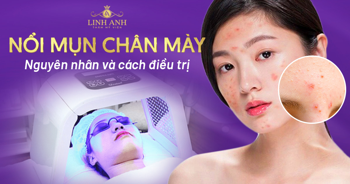 nổi mụn ở chân mày