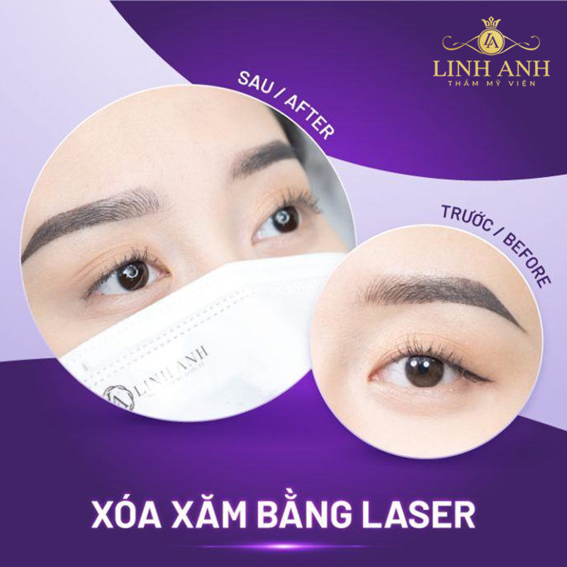 Xóa xăm mí mắt an toàn