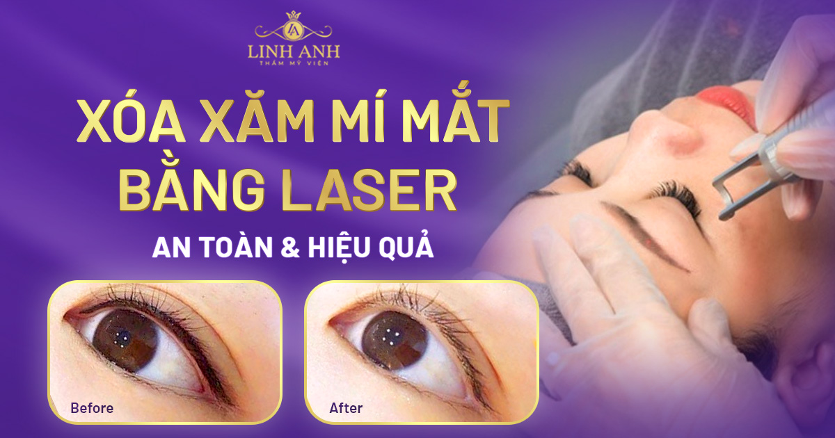 xóa xăm mí mắt