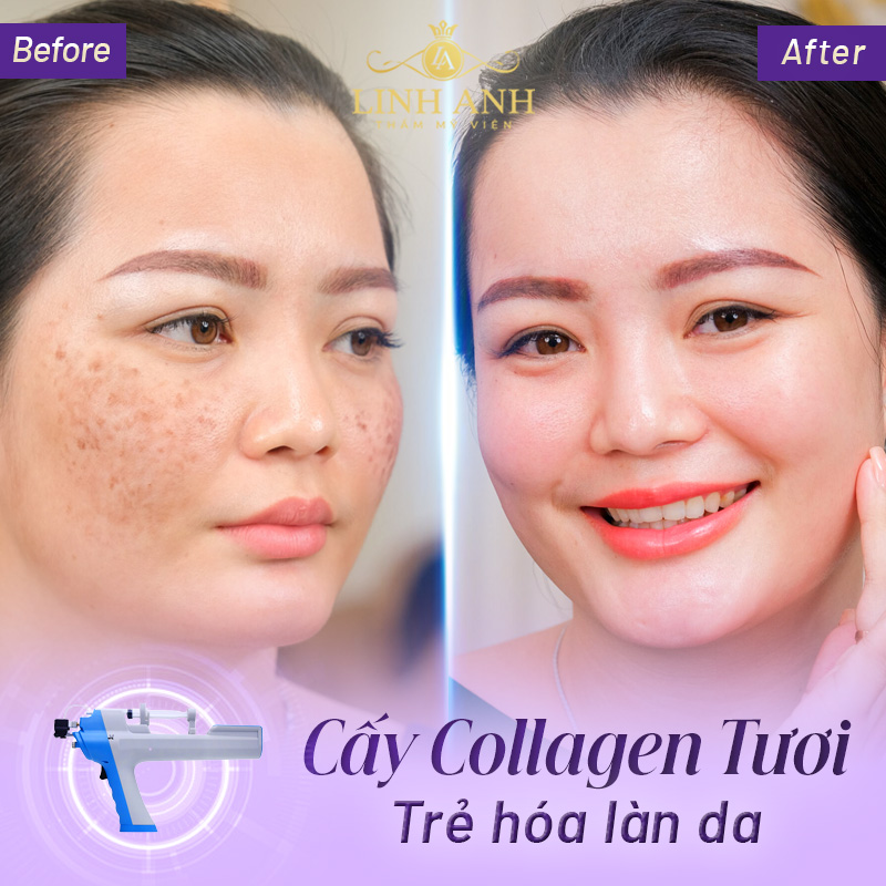 cấy collagen bao nhiêu tiền