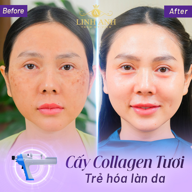 cấy collagen tươi giá bao nhiêu tiền