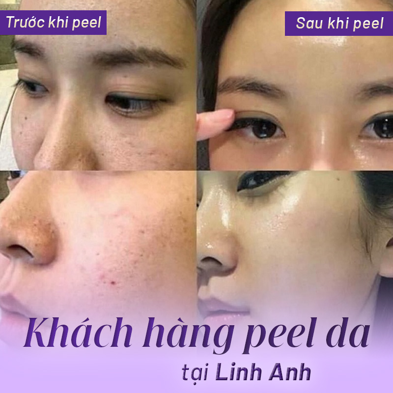 chemical peel giá bao nhiêu