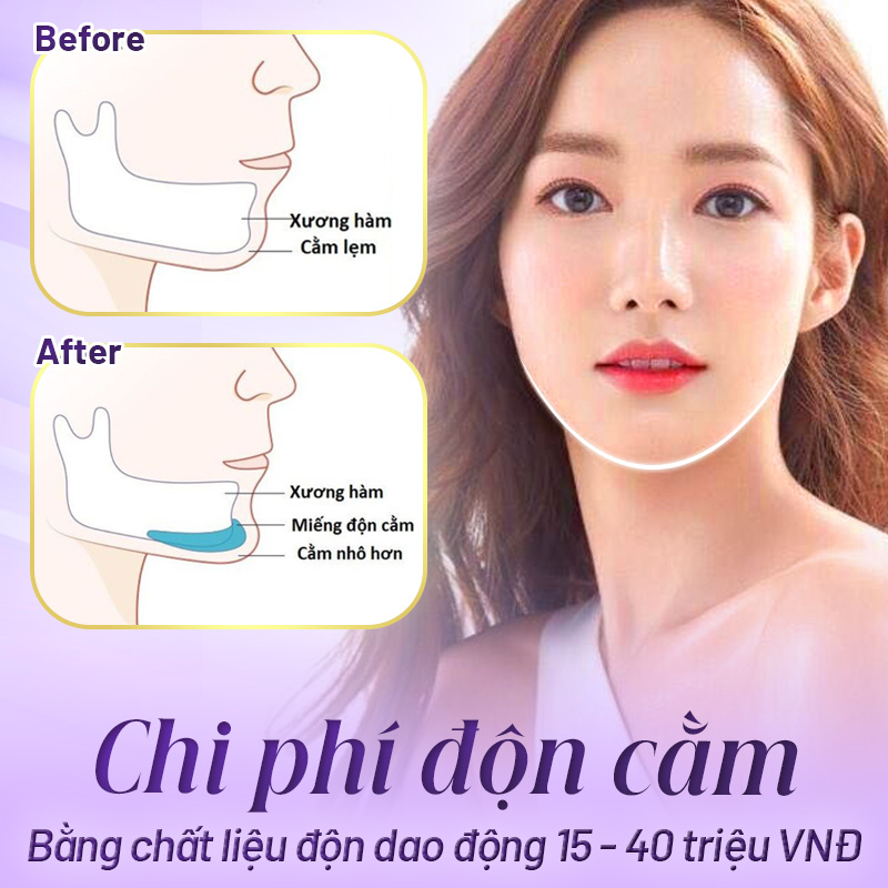 chi phí độn cằm