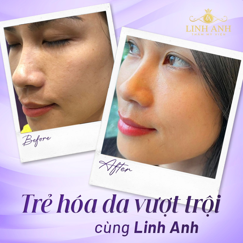 chi phí tiêm bap 5 điểm