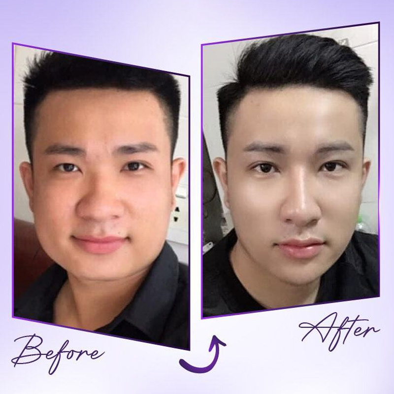 chi phí tiêm botox gọn hàm