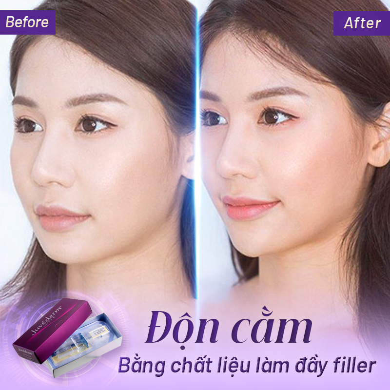 độn cằm hết bao nhiêu tiền