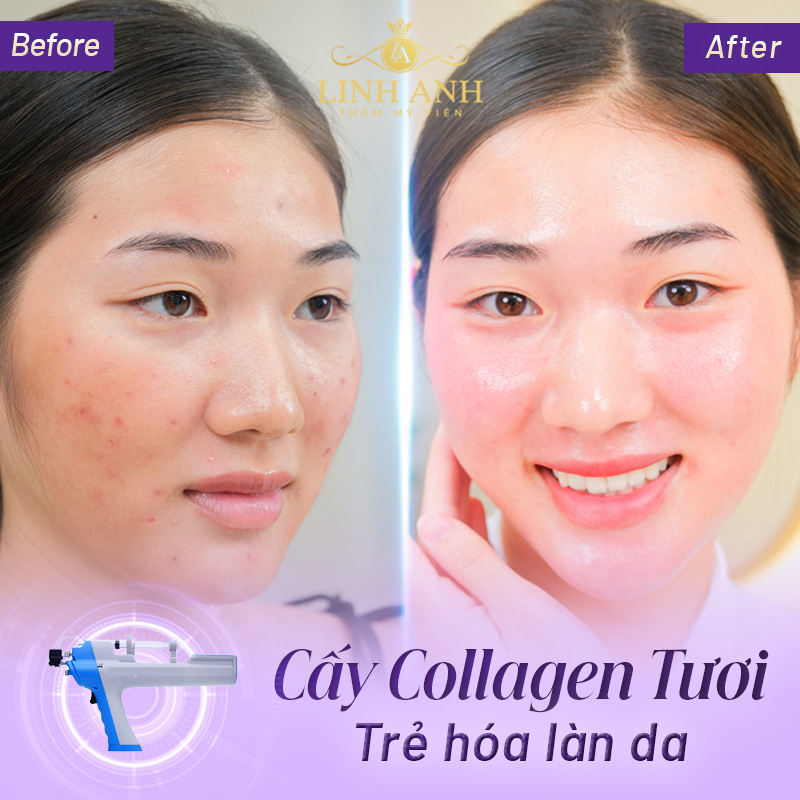 giá cấy collagen tươi