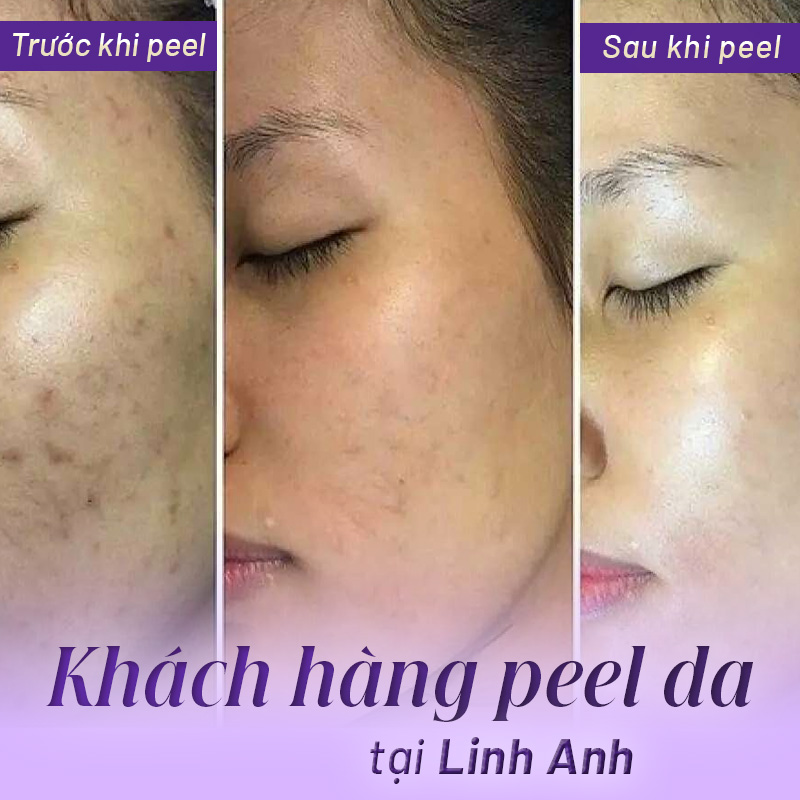 giá peel da tại spa