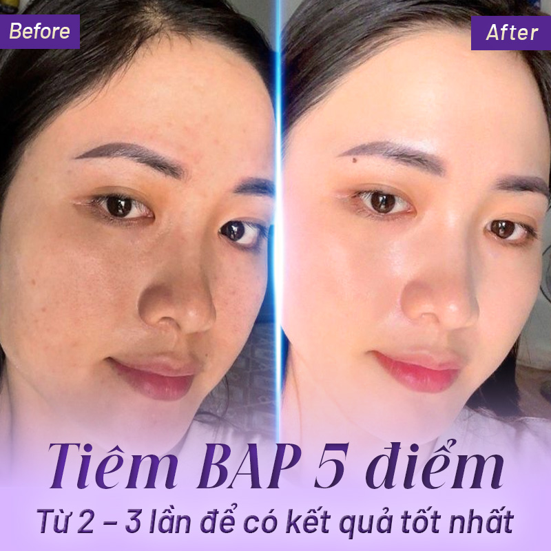 tiêm bap giá