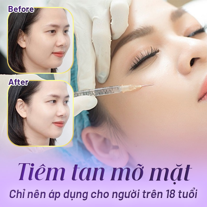 tiêm tan mỡ mặt bao nhiêu tiền