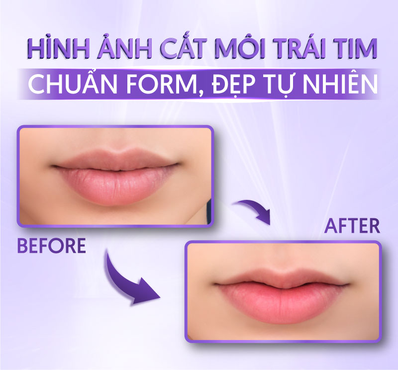 bảng giá cắt môi trái tim mới nhất - Viện thẩm mỹ quốc tế Linh Anh