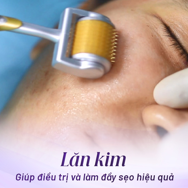 cách điều trị sẹo