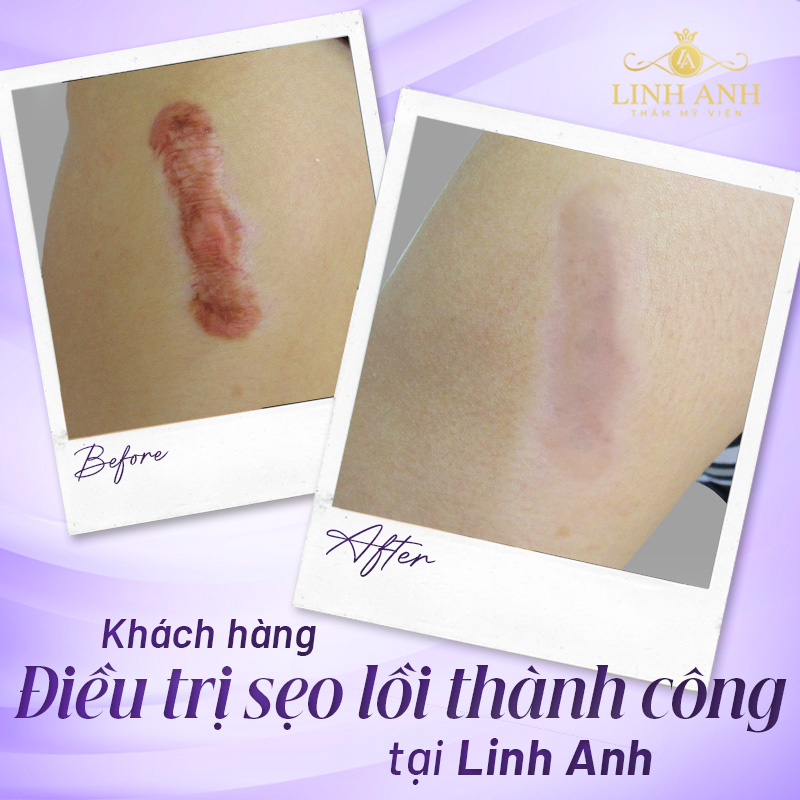 cách khắc phục sẹo