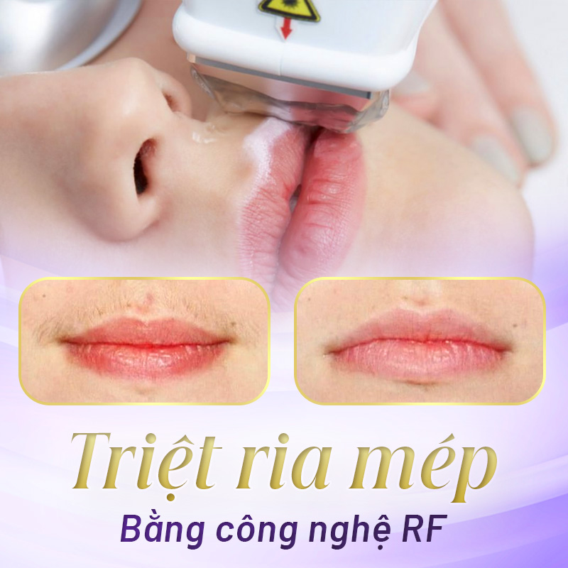 cách triệt lông mép