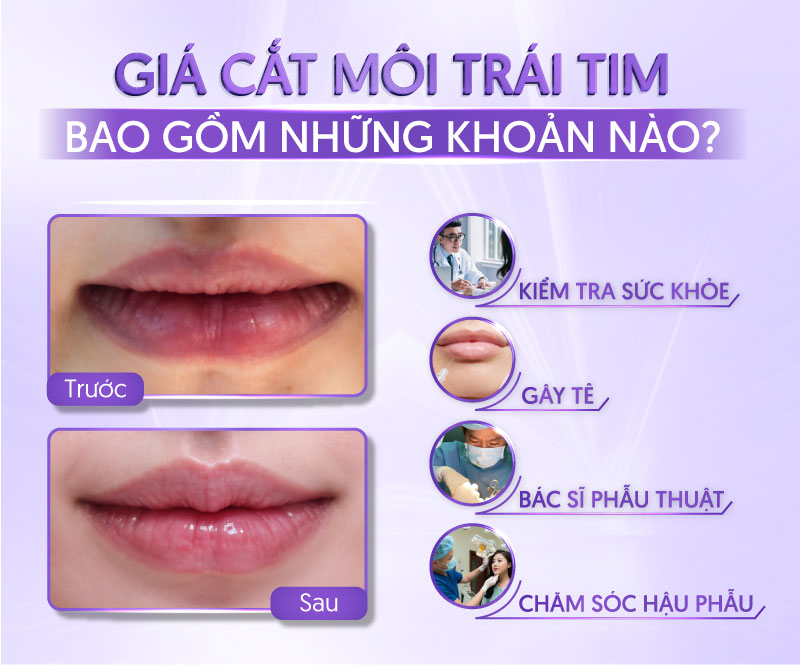 cắt môi trái tim bao nhiêu tiền - Viện thẩm mỹ quốc tế Linh Anh