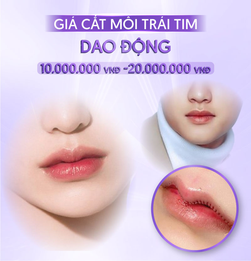 cắt môi trái tim bao nhiêu - Viện thẩm mỹ quốc tế Linh Anh