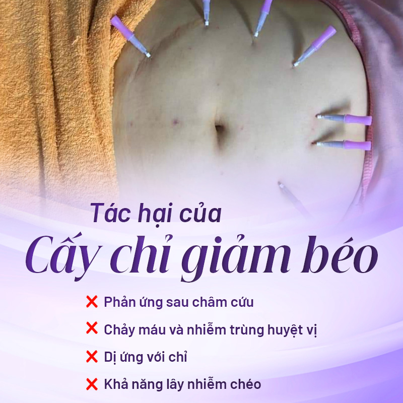 cấy chỉ giảm mỡ bụng