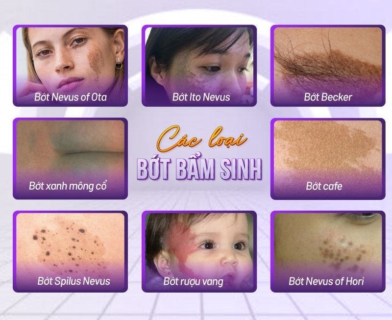 chi phí điều trị bớt sắc tố chi phí điều trị bớt sắc tố