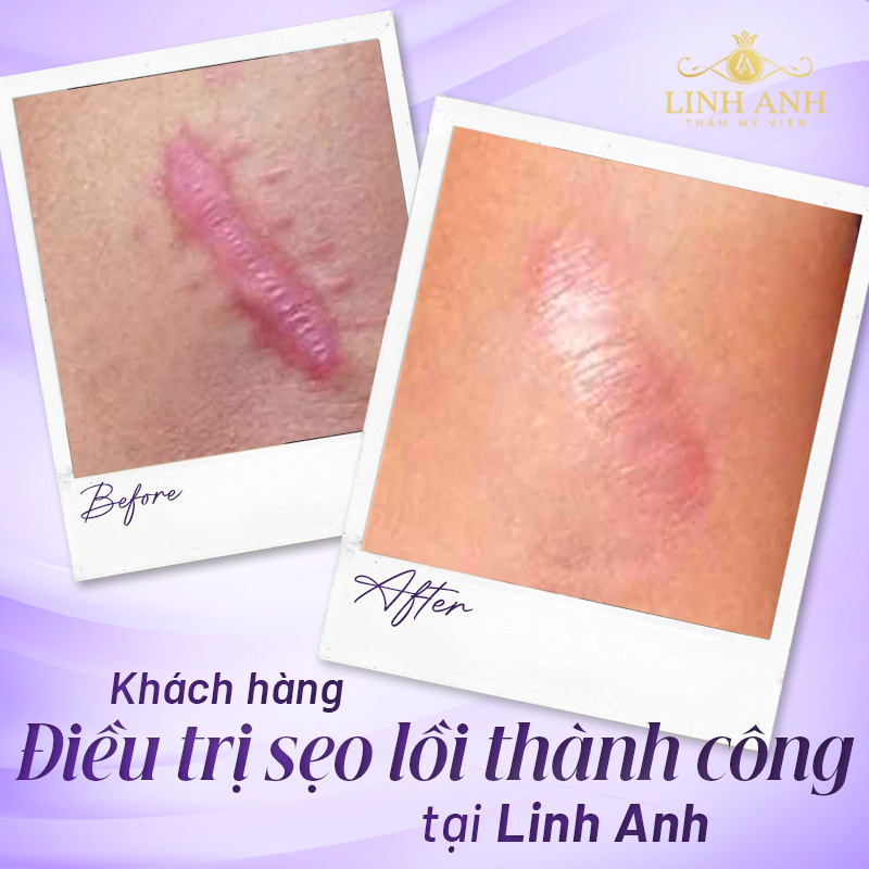 chữa sẹo hiệu quả
