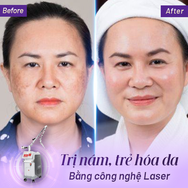 công nghệ căng bóng trẻ hóa da