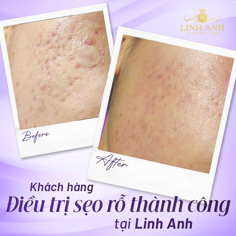công nghệ điều trị sẹo an toàn