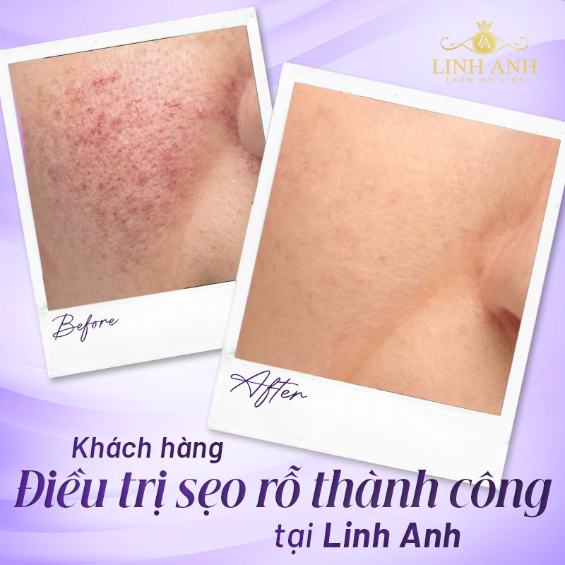điều trị sẹo an toàn
