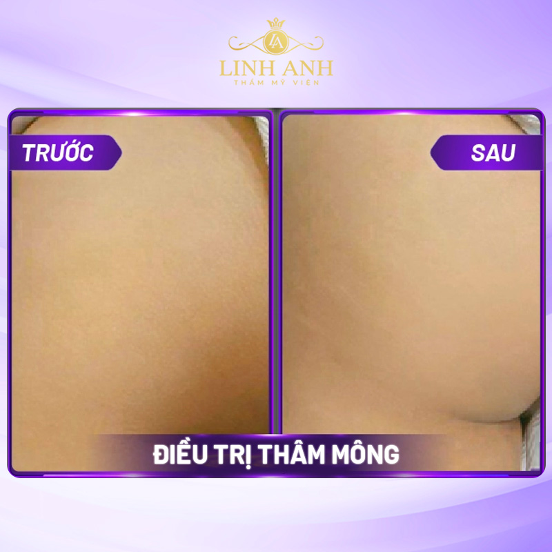 điều trị thâm công nghệ cao