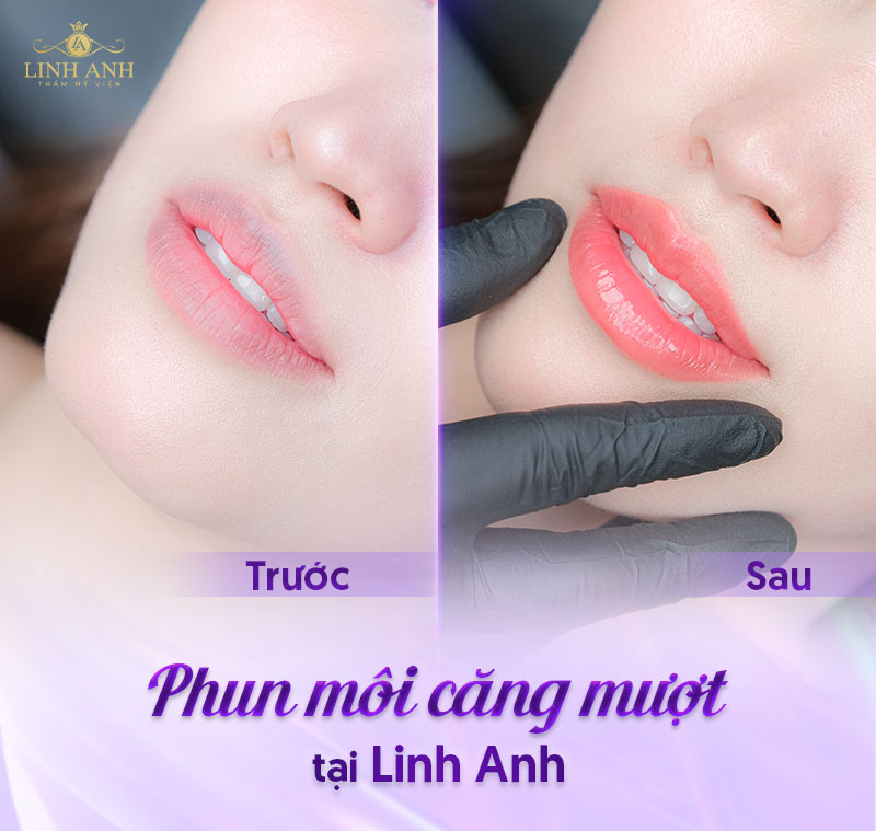 Khử thâm viền môi hiệu quả - Viện thẩm mỹ quốc tế Linh Anh