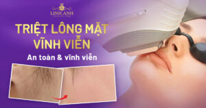 triệt lông mặt