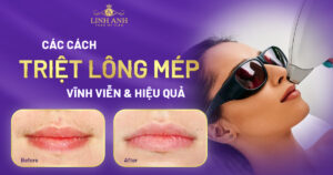 triệt lông mép