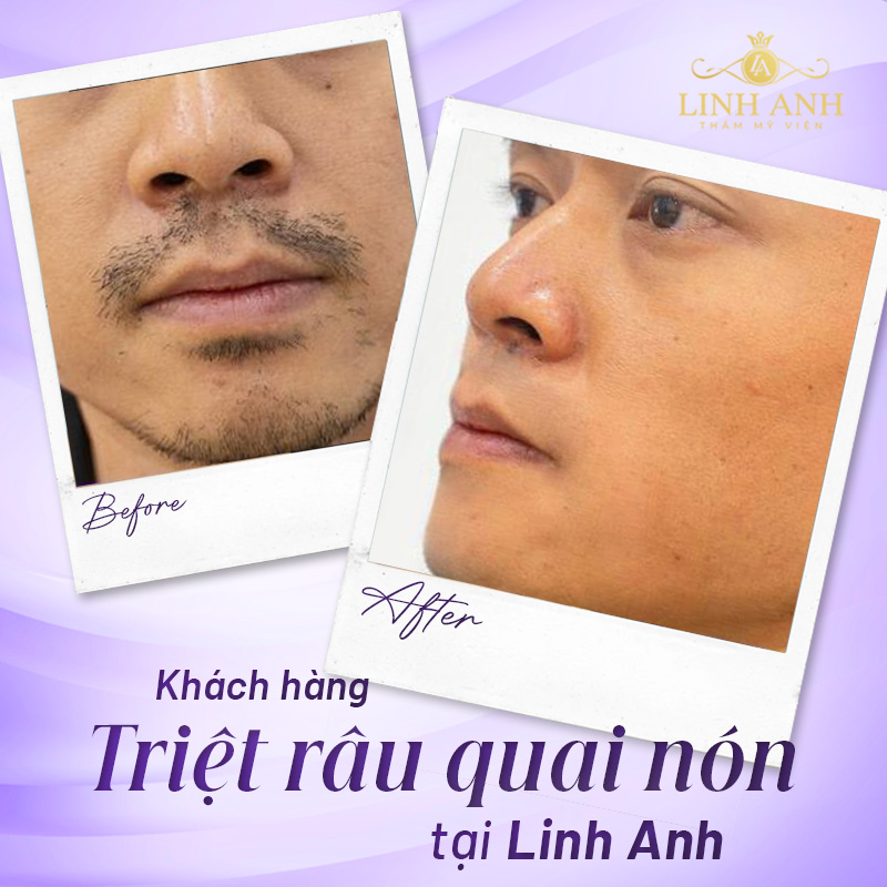 triệt râu quai nón an toàn