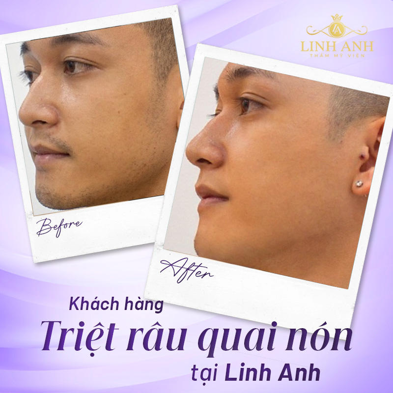 triệt râu quai nón nam
