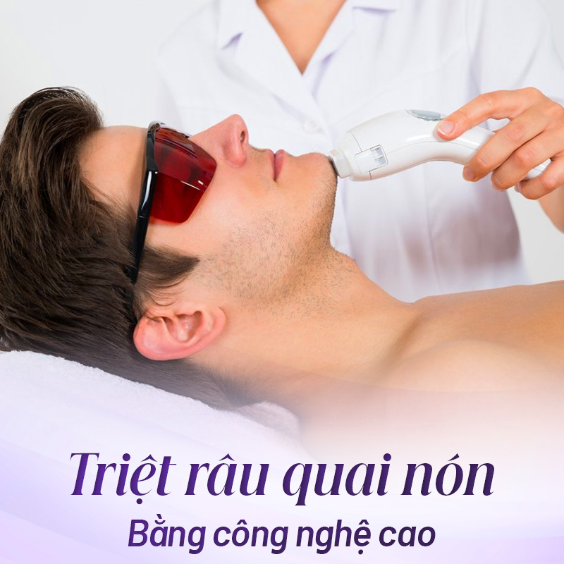 triệt râu quai nón tại Linh Anh