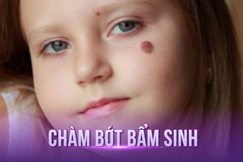 xoá vết chàm bao nhiêu tiền xoá vết chàm bao nhiêu tiền