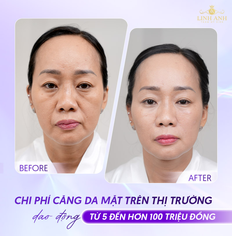 Căng da mặt giá bao nhiêu tiền