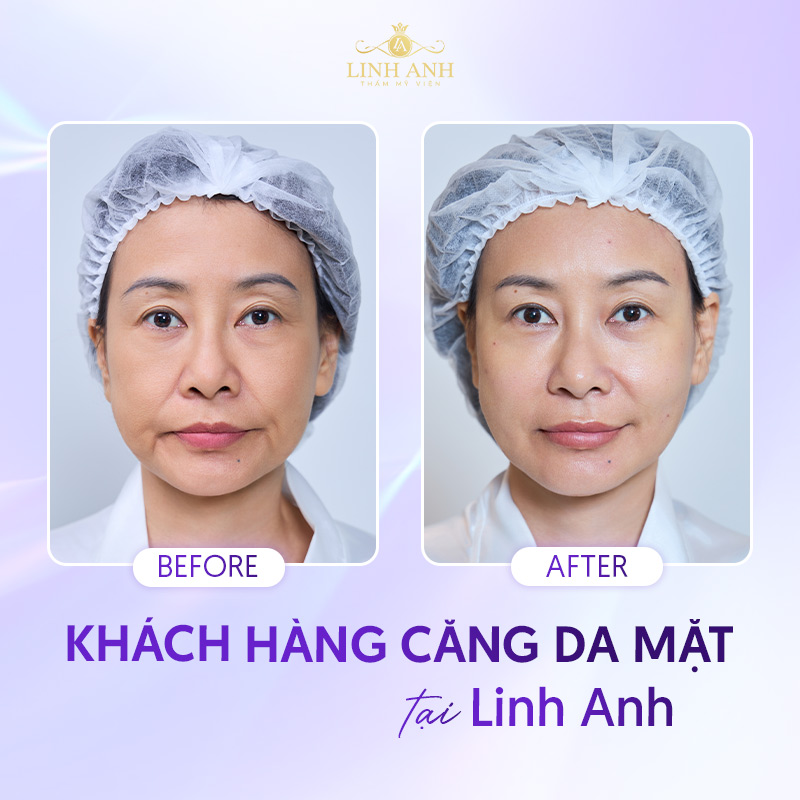 Căng da mặt tại Linh Anh