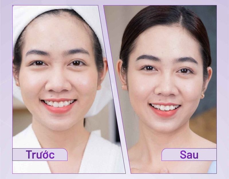 Chi phi phau thuat don thai duong