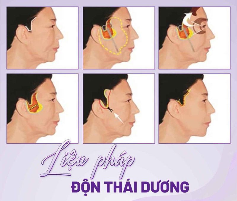 Don thai duong bao nhieu tien 1