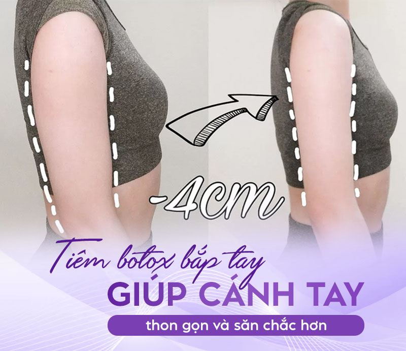giá tiêm tan mỡ bắp tay