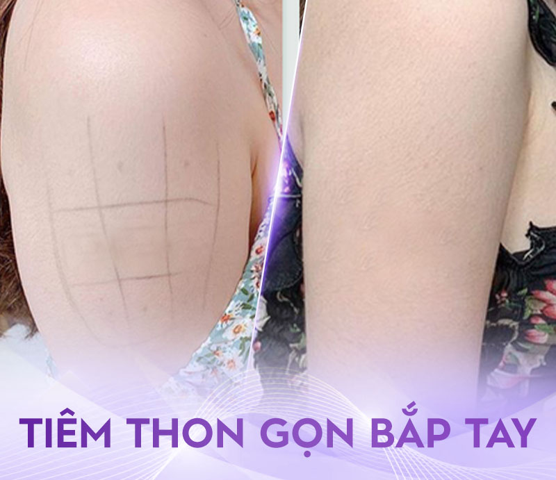 tiêm tan mỡ bắp tay giá bao nhiêu tiêm tan mỡ bắp tay giá bao nhiêu