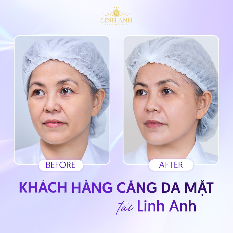 bang giá Căng da mặt