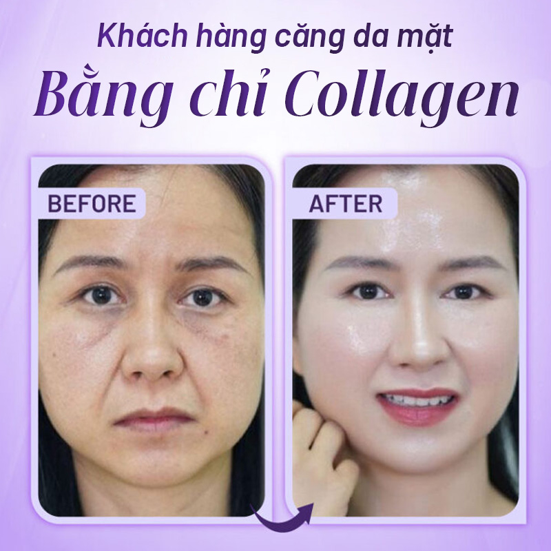 bảng giá căng chỉ collagen